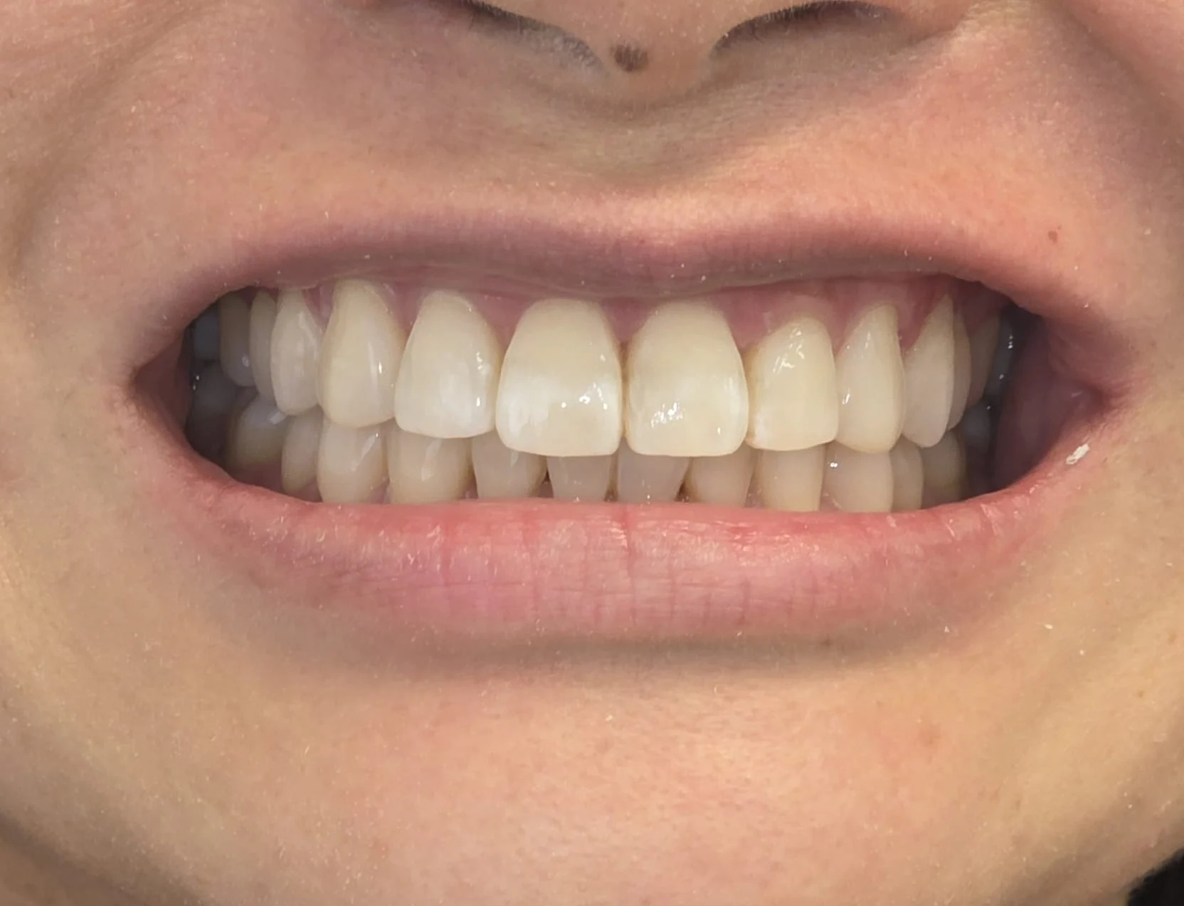 invisalign-case11