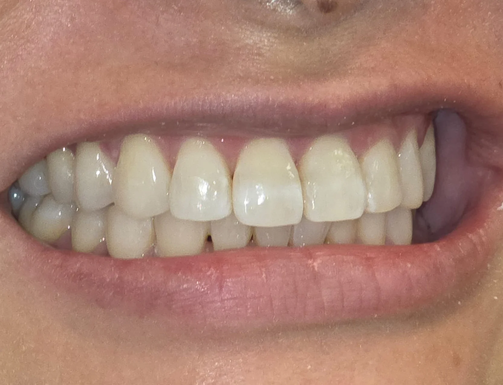 invisalign-case11111