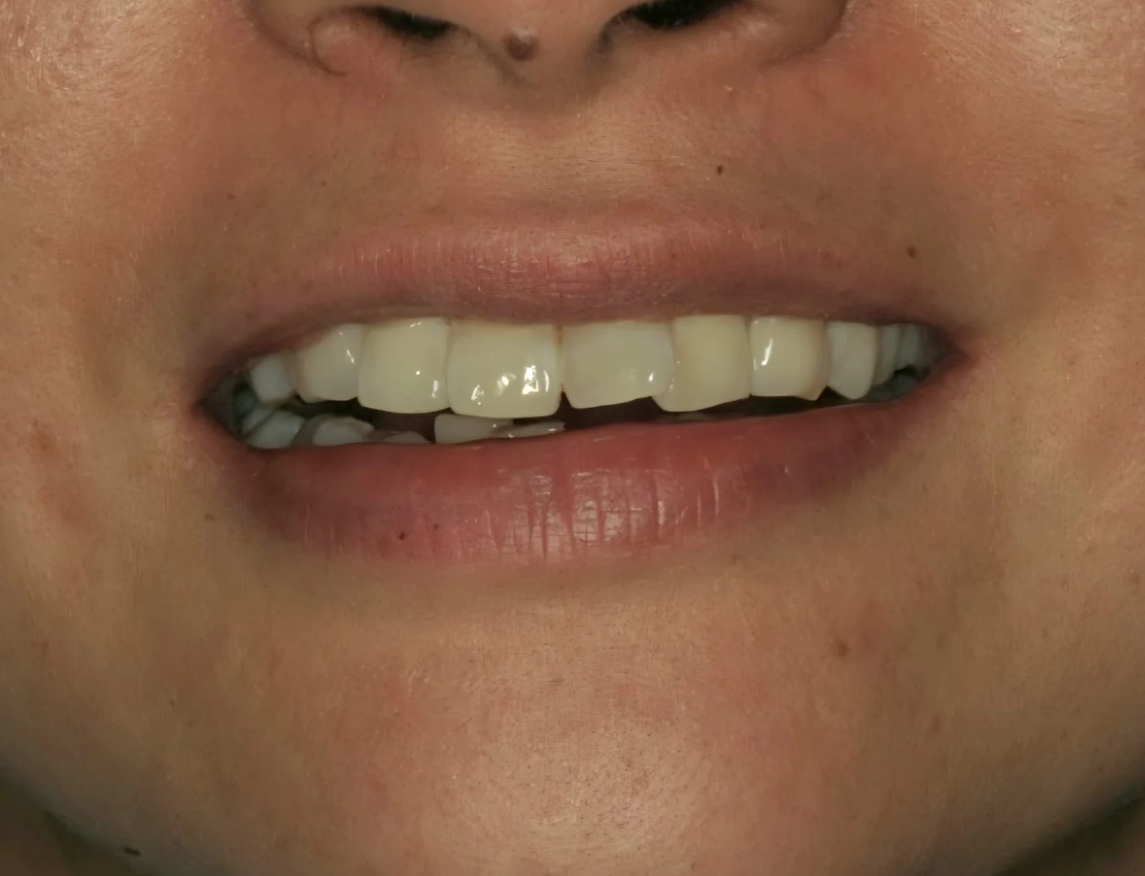 invisalign-case122