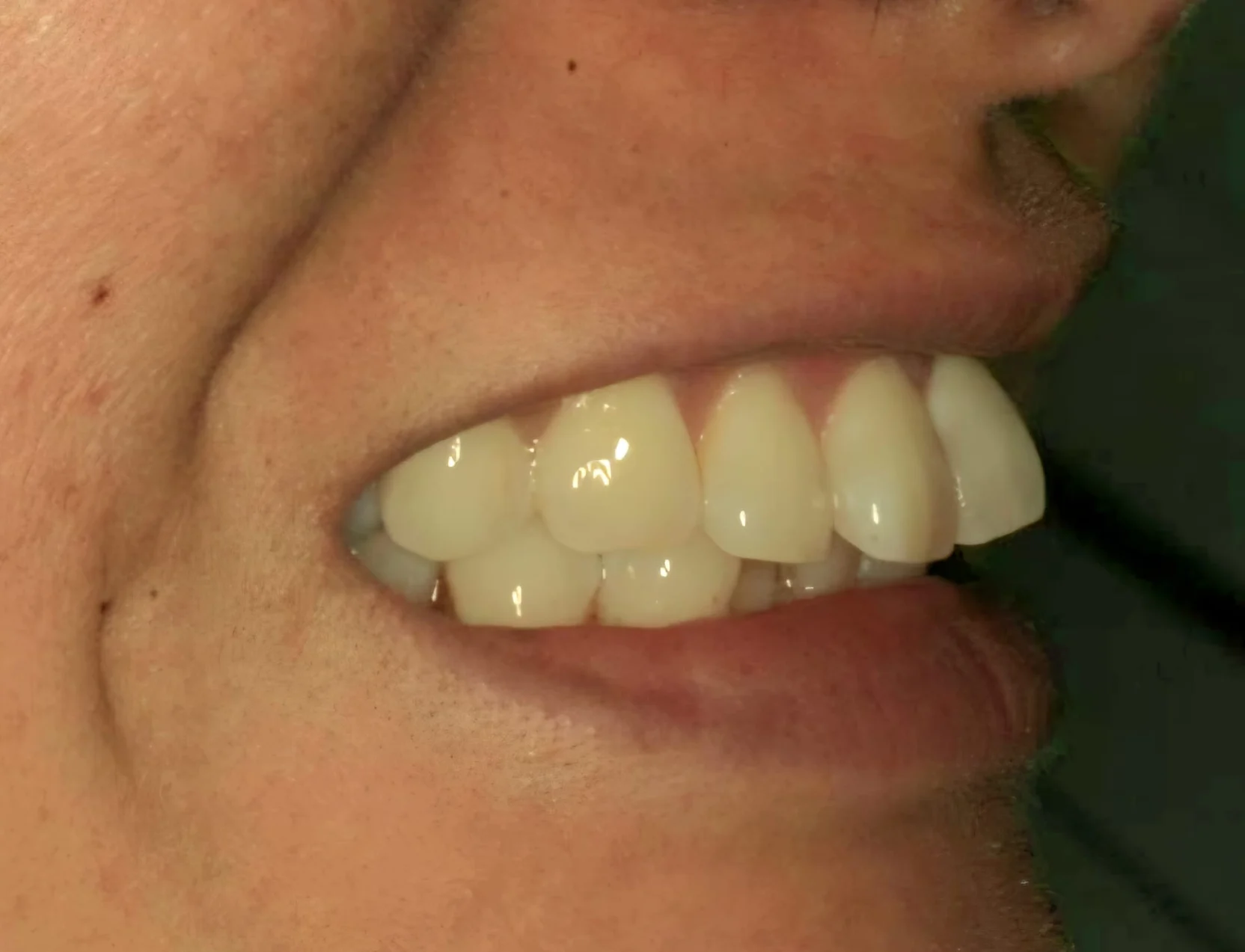 invisalign34-case11111